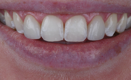 AA-Case-2-After