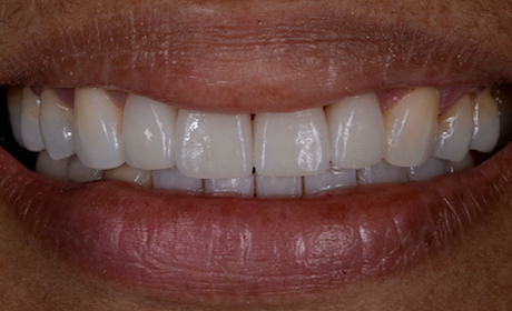 AA-Case-6-After