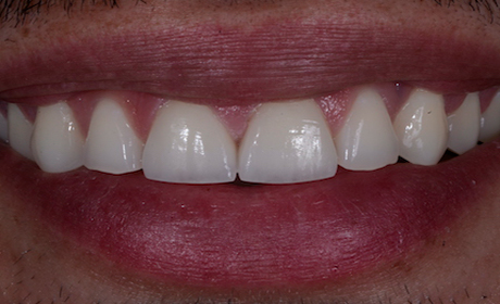 AA-Case-9-After