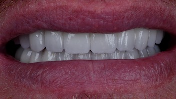 FULL-MOUTH RECONSTRUCTION - AFTER