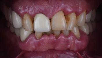 FULL-MOUTH RECONSTRUCTION - BEFORE