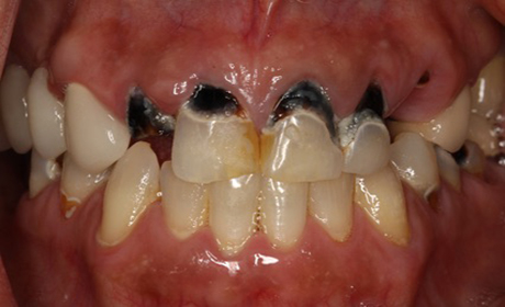 Implants-B3