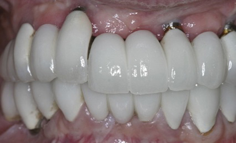Implants-Rehab-B2