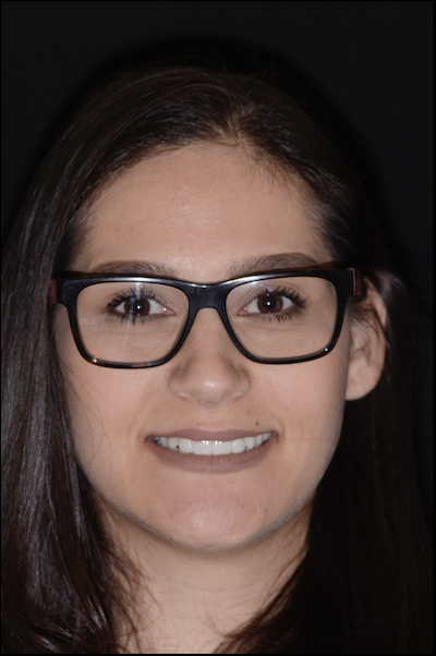 NO-PREPARATION VENEERS