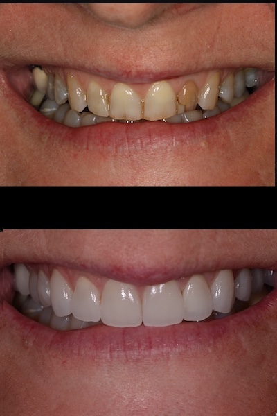 VENEERS AND CROWNS