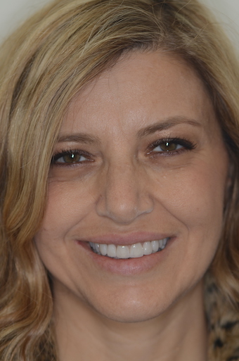 VENEERS