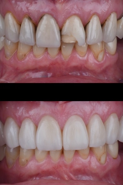 VENEERS2