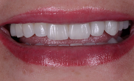 Veneer-A1