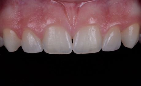 Veneers-After-Misshape