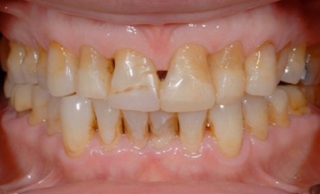 Veneers-B1