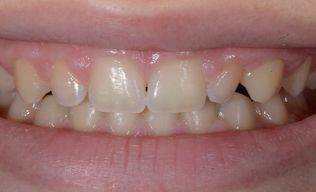 Veneers-Before-Misshape