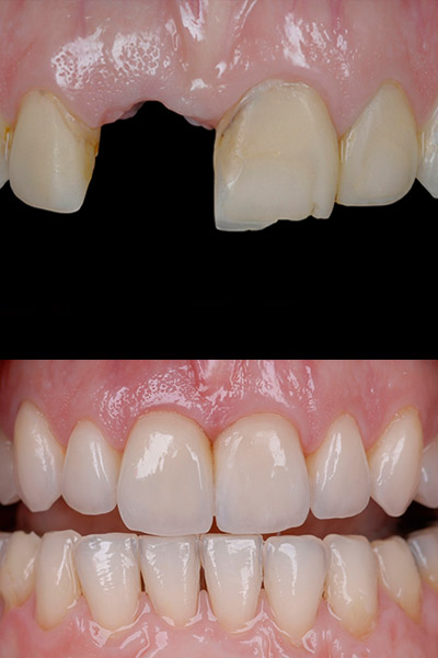 smile-04-bna-full