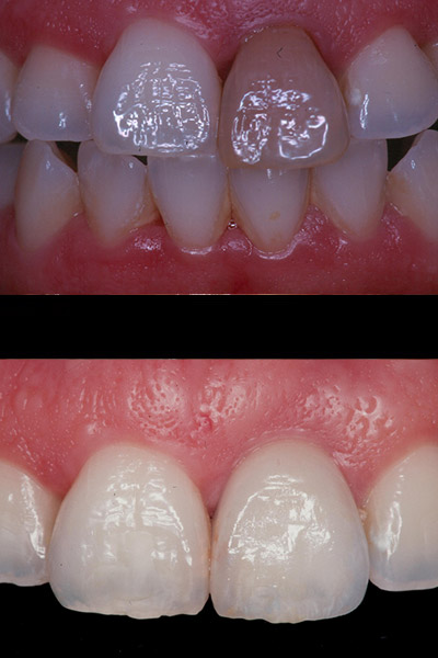 smile-15-bna-full
