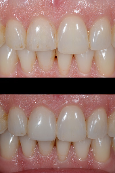 smile-17-bna-full