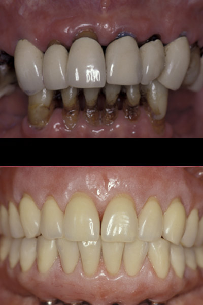 smile-22-bnar-full