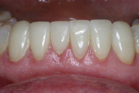 smile-24-after