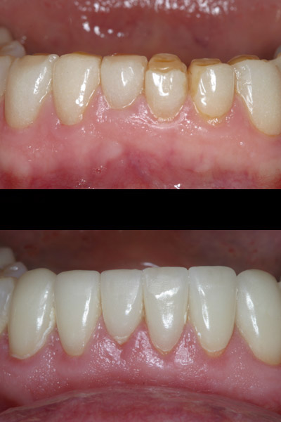 smile-24-bnar-full