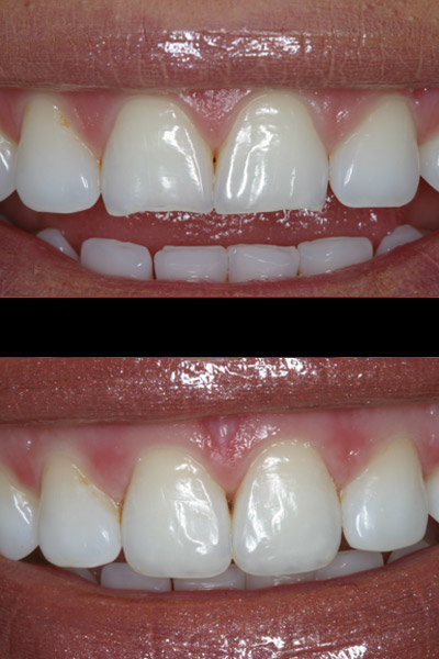 smile-29-bnar-full