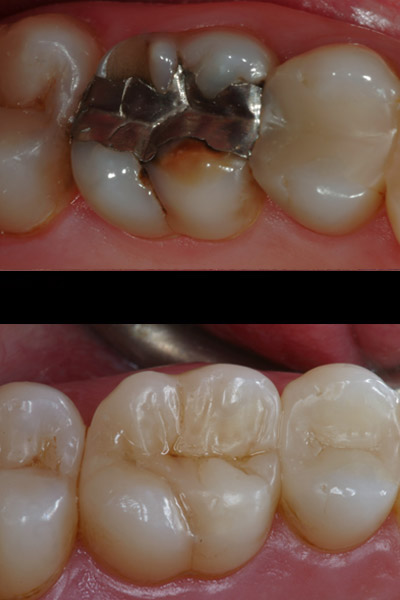 smile-30-bnar-full