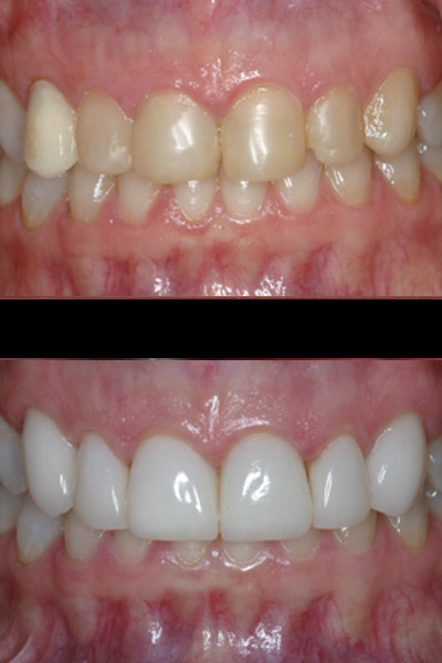 smile-31-bnar-full