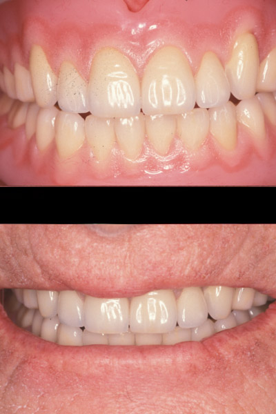 smile-32-bnar-full