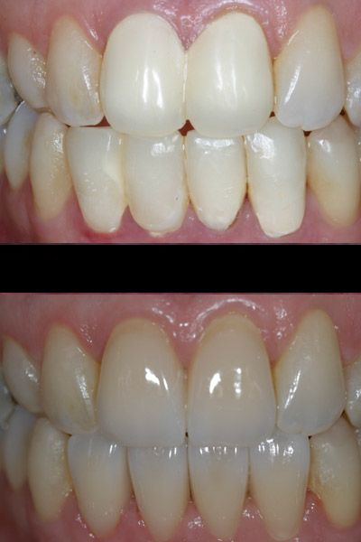 smile-34-bnar-full