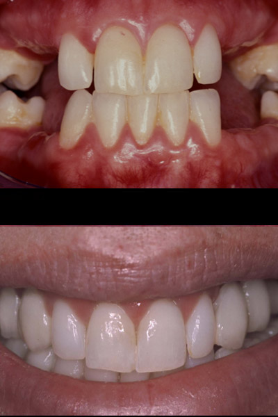 smile-37-bnar-full