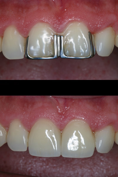 smile-38-bnar-full