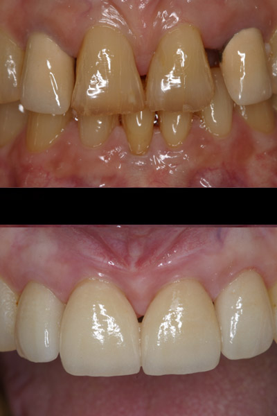 smile-39-bnar-full