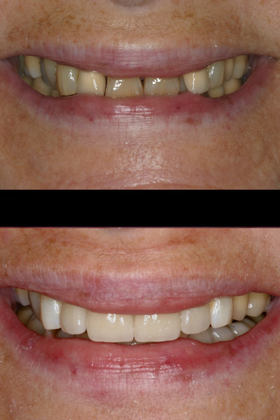 smile-40-bnar-full