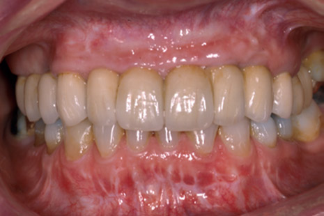 smile-43-after