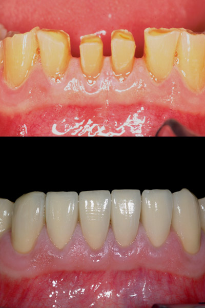 smile-45-bnar-full