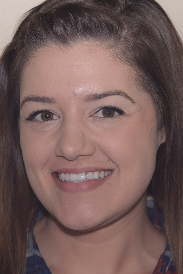 smile-implant-1-after-full